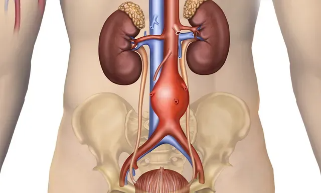 Abdominal Aortic Aneurysm (AAA)