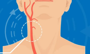 Carotid Endarterectomy - Advanced Vascular & Vein Associates